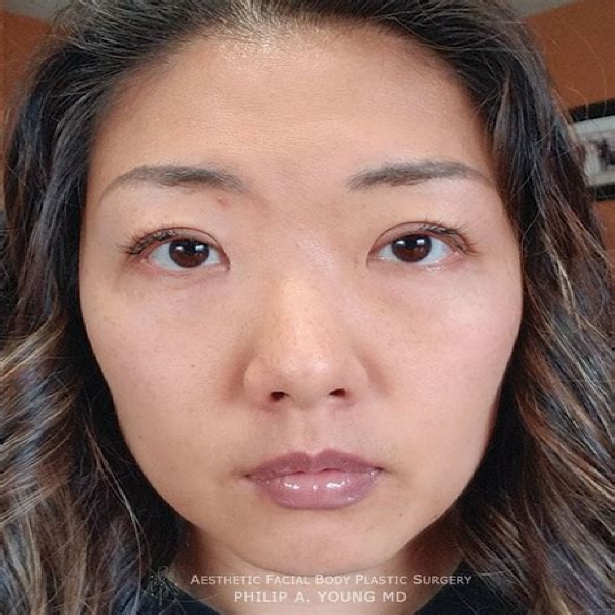 Before And After For Asian Eyelids